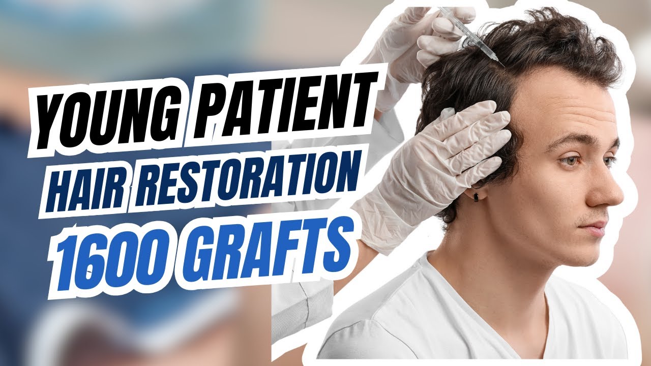Young Patient’s #hairlinerestoration : with Just 1600 #grafts!