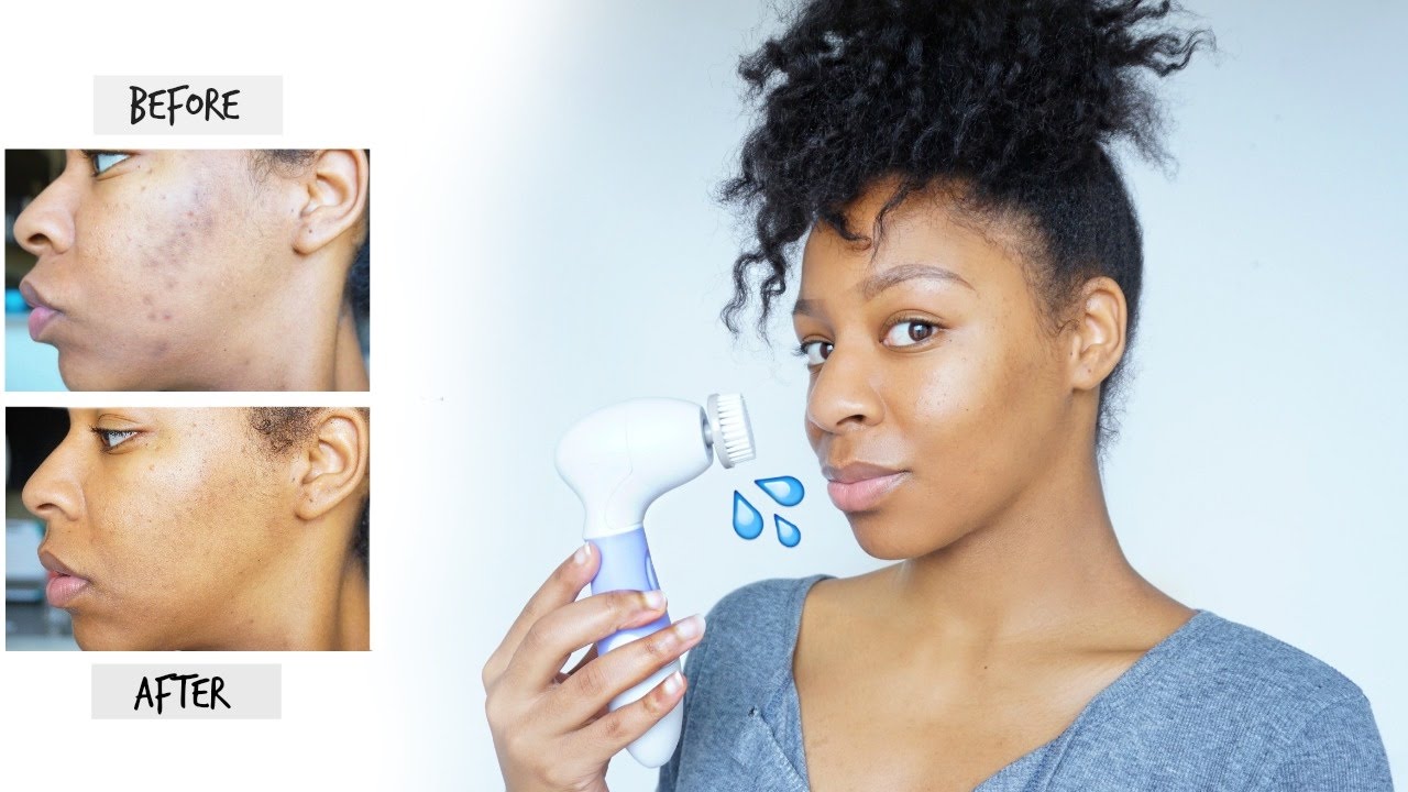 How I Remove Dark Spots & Acne Scars | Skincare Routine for Hyperpigmentation