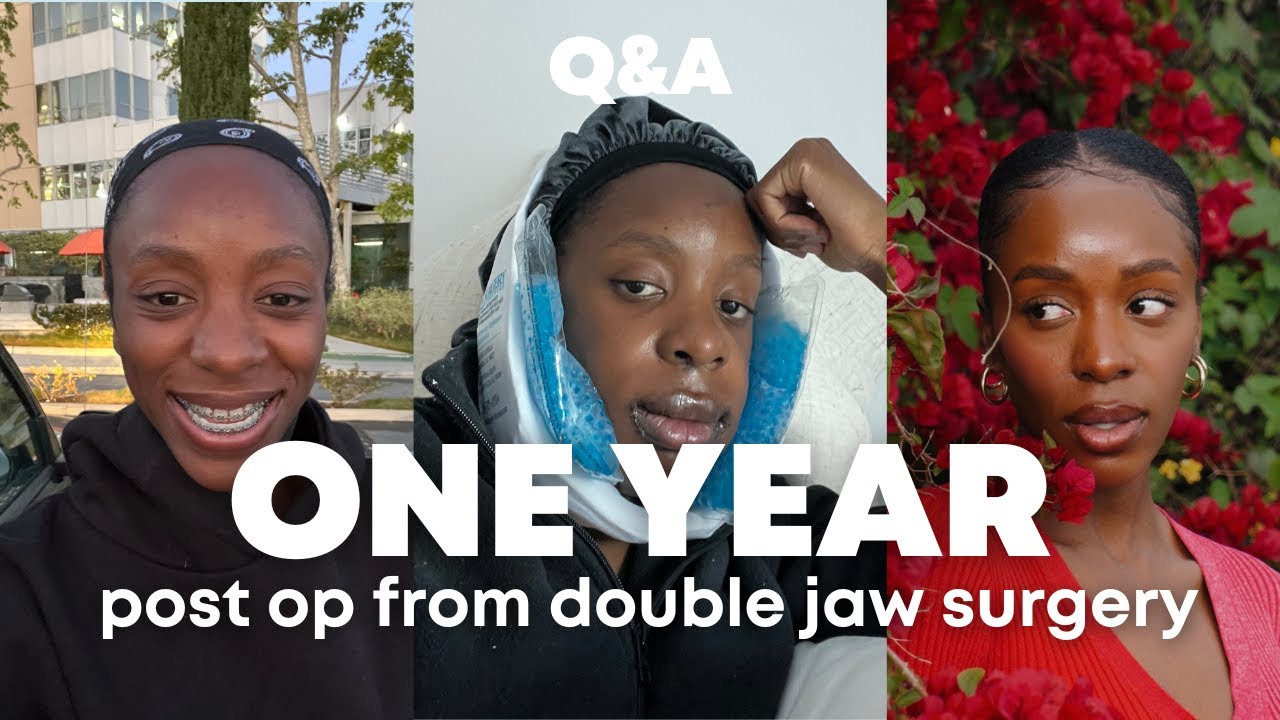 JAW SURGERY Q&A: ONE YEAR POST OP FROM DOUBLE JAW SURGERY *emotional*