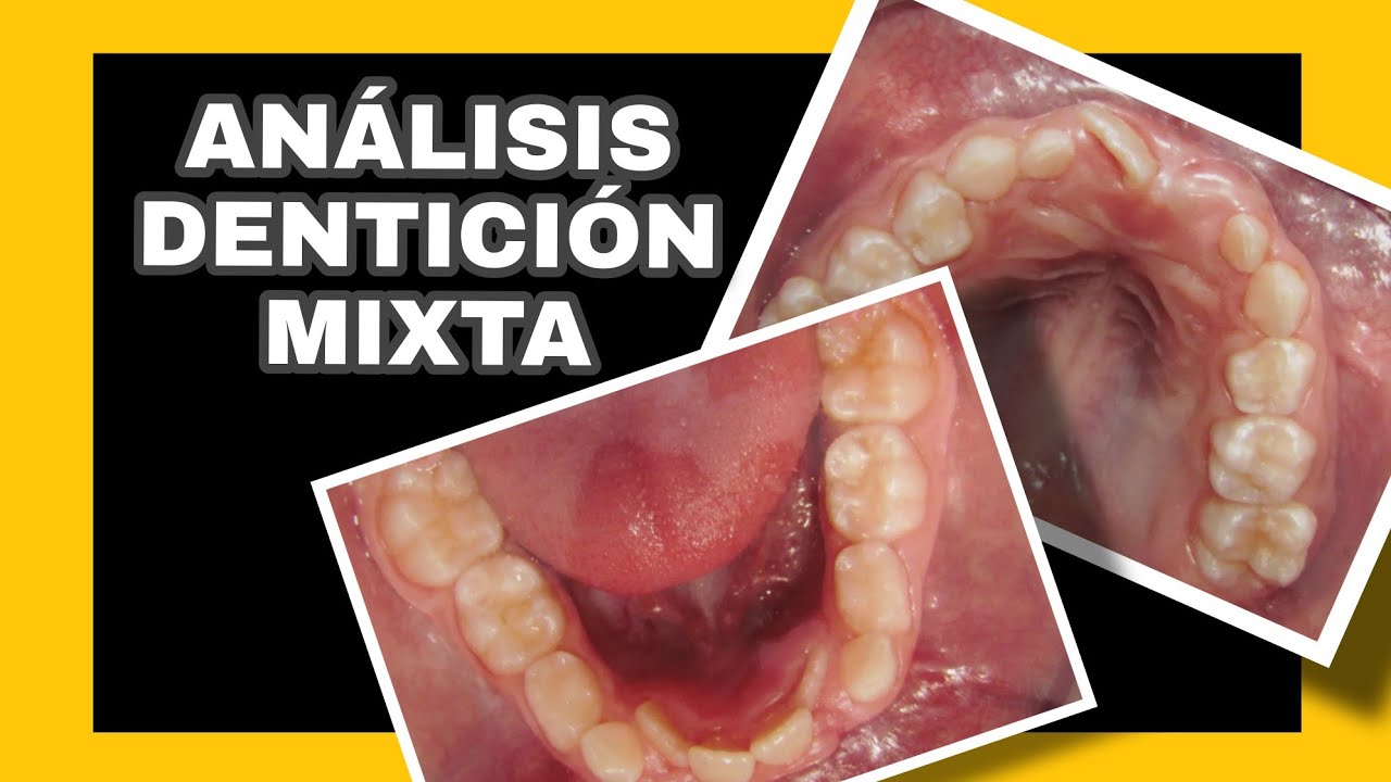 Análisis de dentición mixta