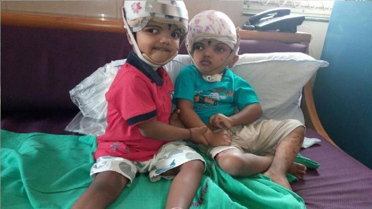 How AIIMS Doctors Conducted Surgery Of Conjoined Odisha Twins