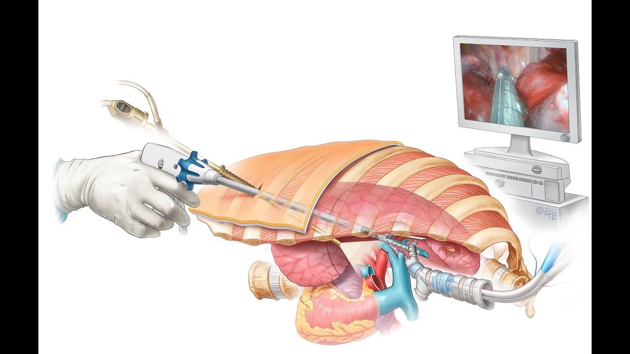 Minimal invasive surgery for lung cancer