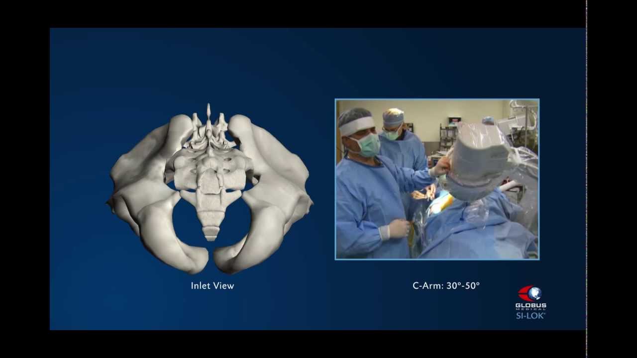 SI-LOK® Sacroiliac Joint Fixation System