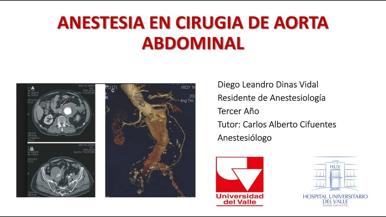 Anestesia en Cirugía de Aorta Abdominal