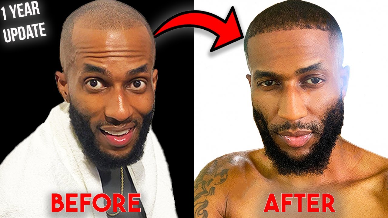 My Afro-Black Hair Transplant 1 Year Results | COOPSCORNER