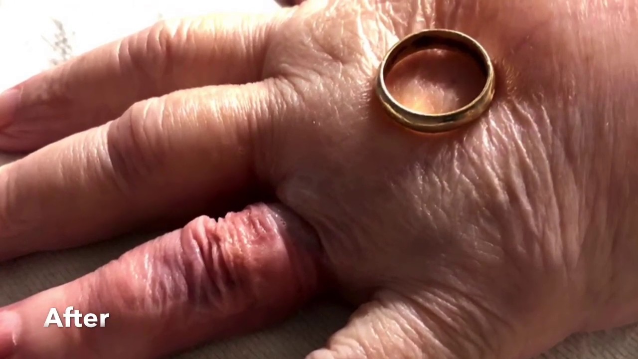 Before & After Stuck Ring Removals Using Ring Rescue Compression Device