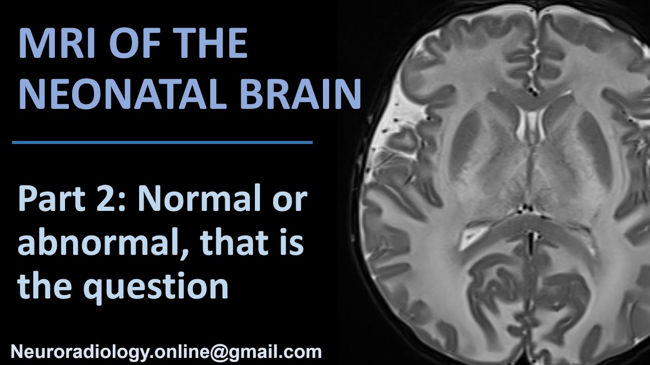 MRI of the neonatal brain, part 2: Normal or abnormal, that is the question...