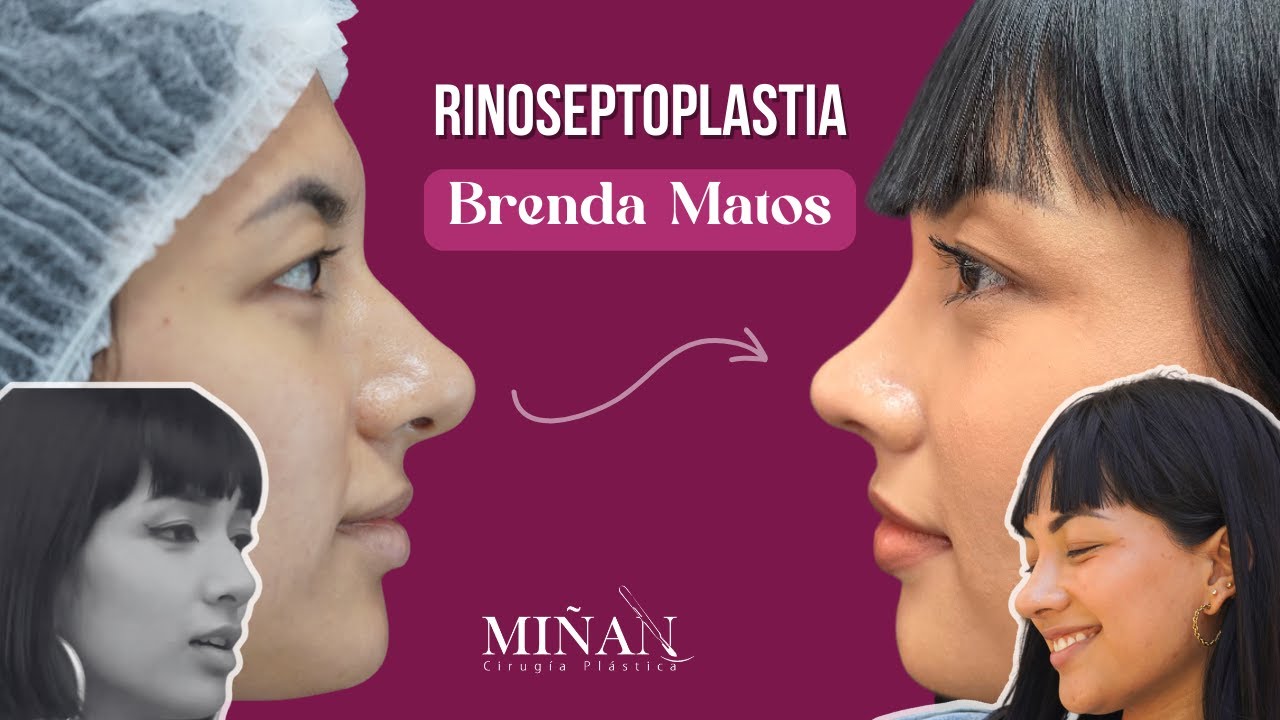 El nuevo perfil de Kimberly (Brenda Matos) de AFHS🤩 | Rino ultrasónica Antes y Después