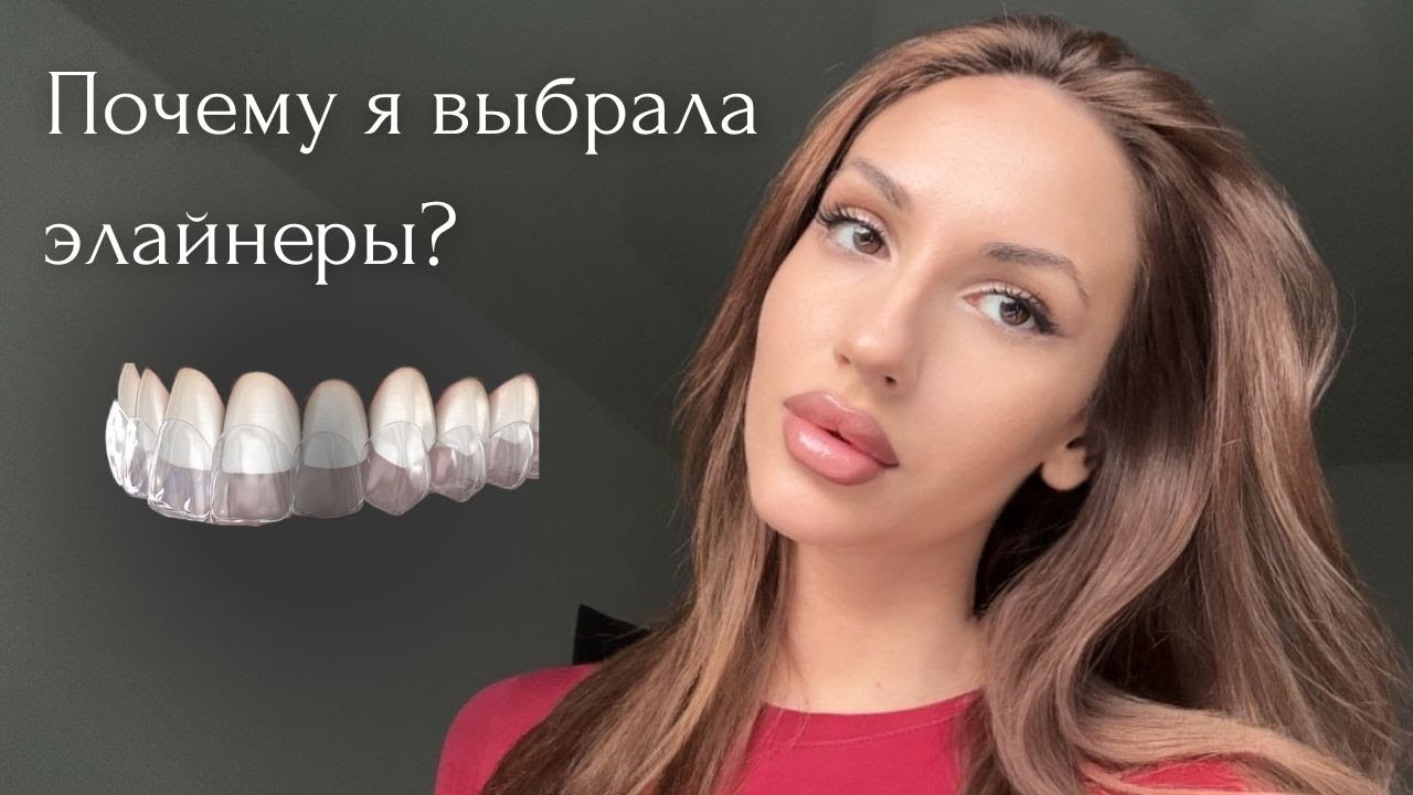 Что выбрать: брекеты или элайнеры? Мой опыт, объясняю и сравниваю.