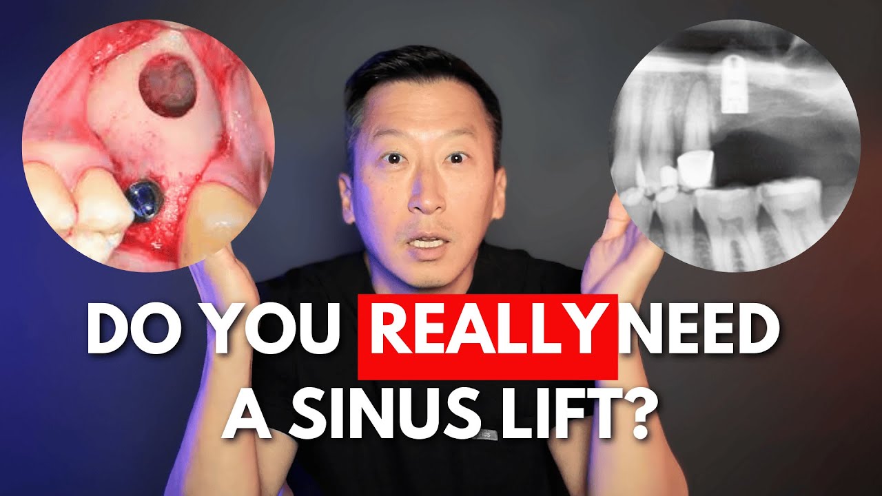 Sinus Lift 101: Lateral vs. Vertical Approach, Bruxism Impact & Must-Know Bone Graft