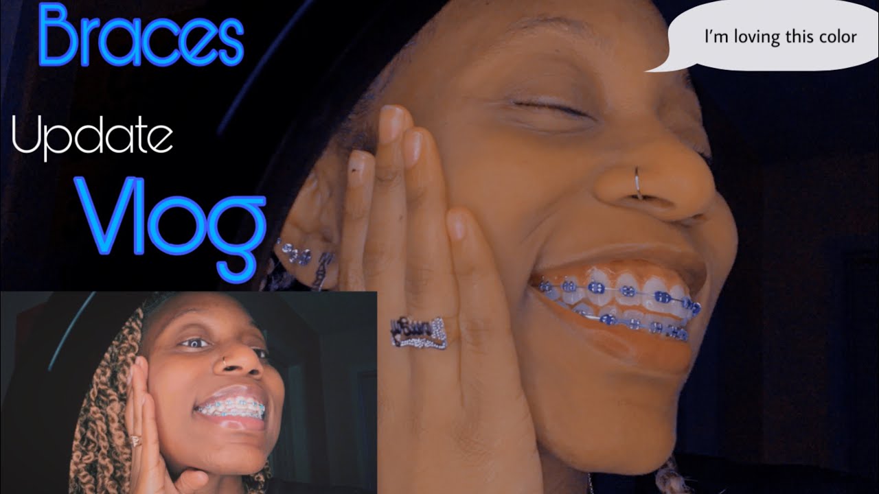Braces Update Vlog 💙🤍🧿🦋