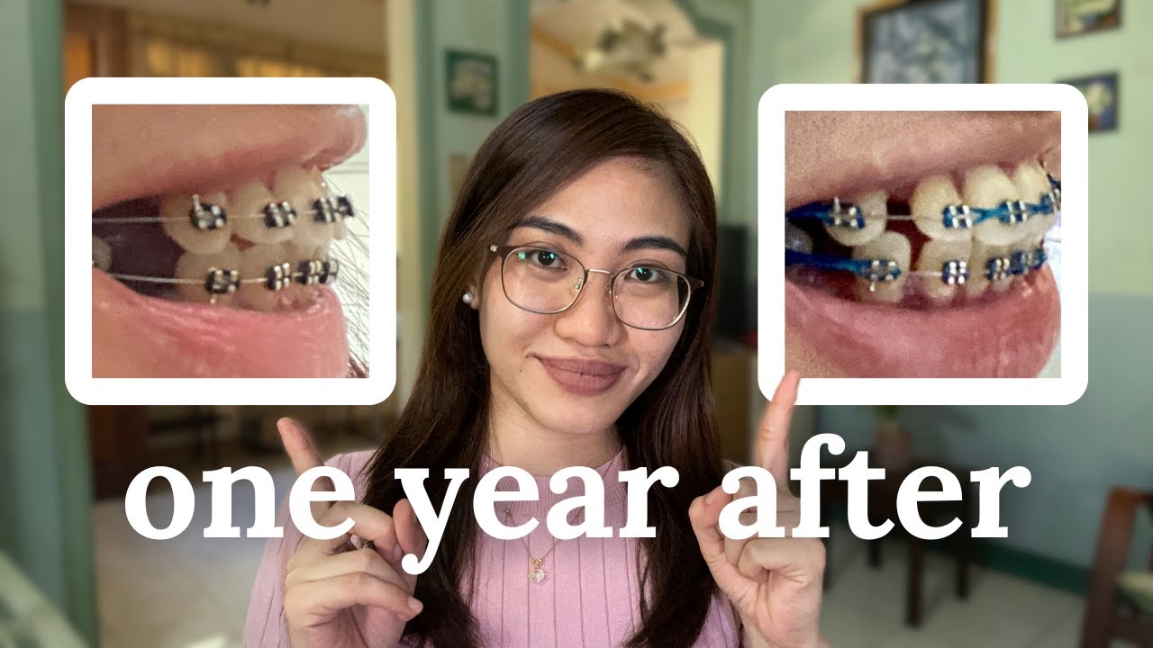 I Got My Premolars Extracted For Orthodontics