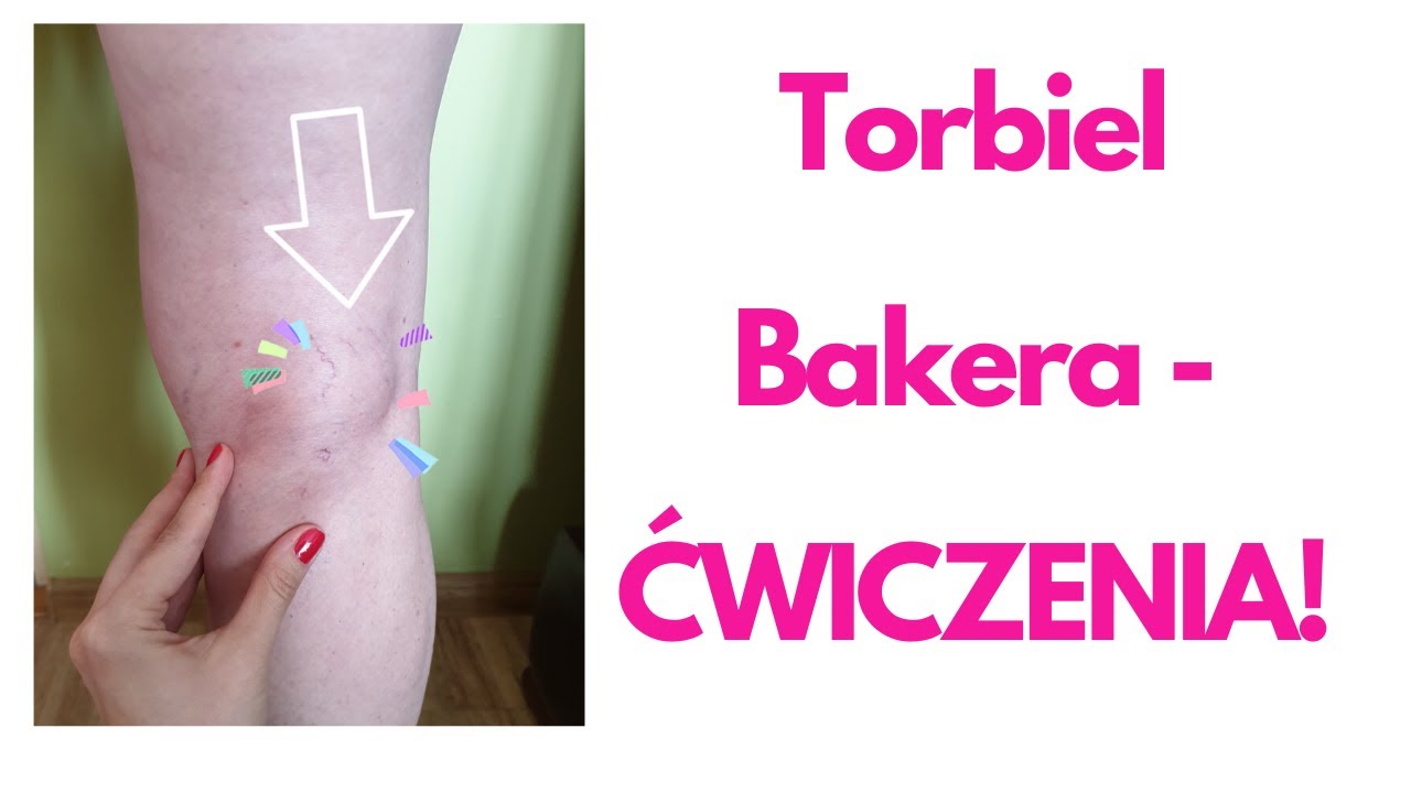 Ćwiczenia cysta Bakera