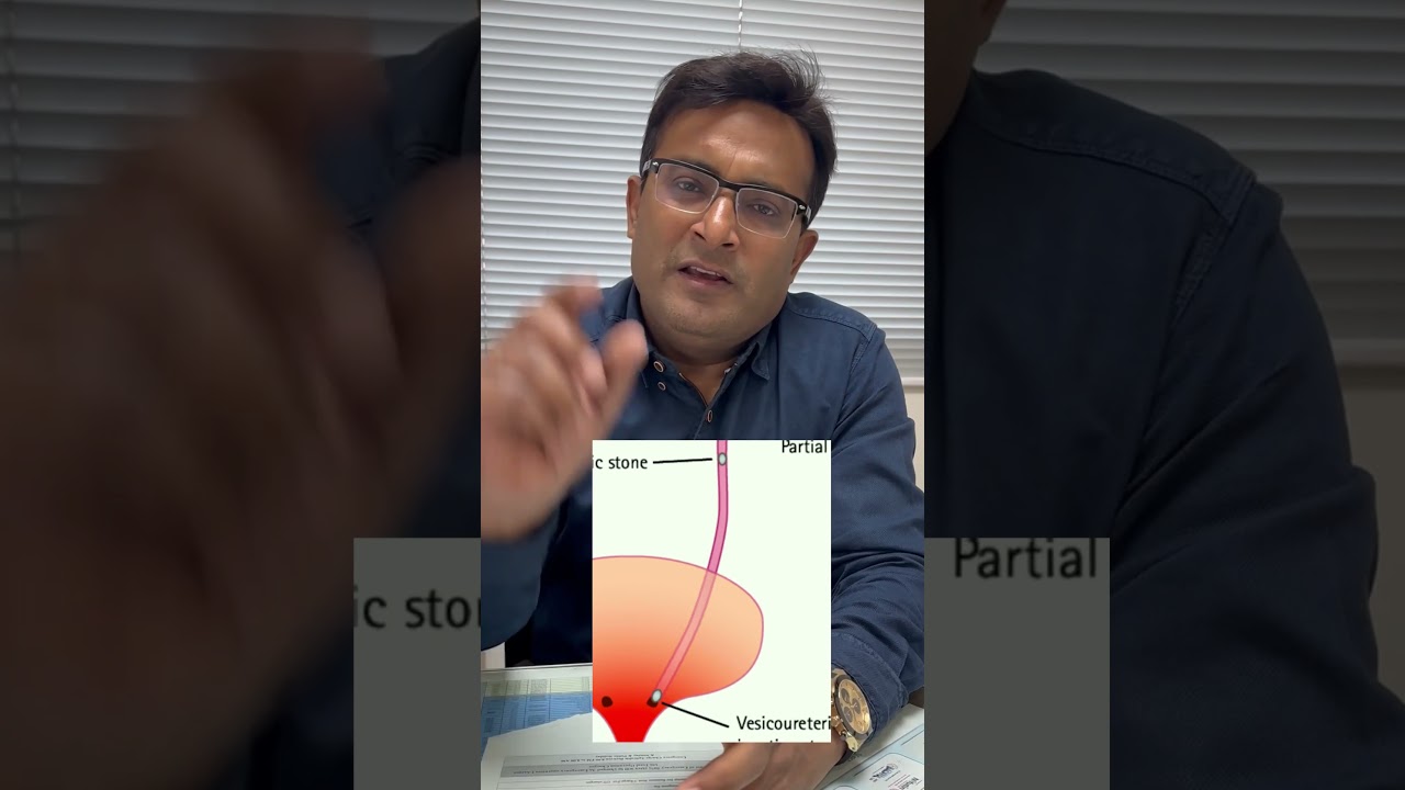 VUJ URETER STONE #uretericstone #kidneystones #kidneystonekailaj
