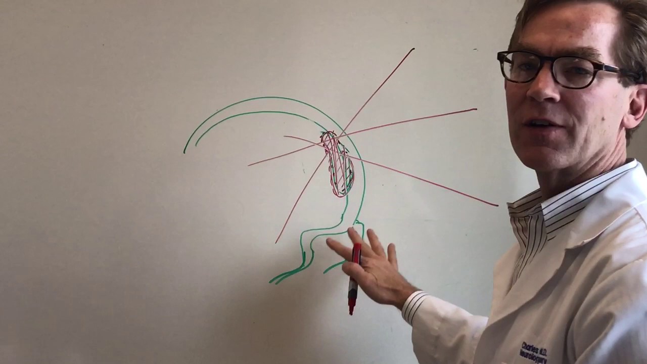 Part 2 of 2 Meningiomas: Brain Tumors 101 Series