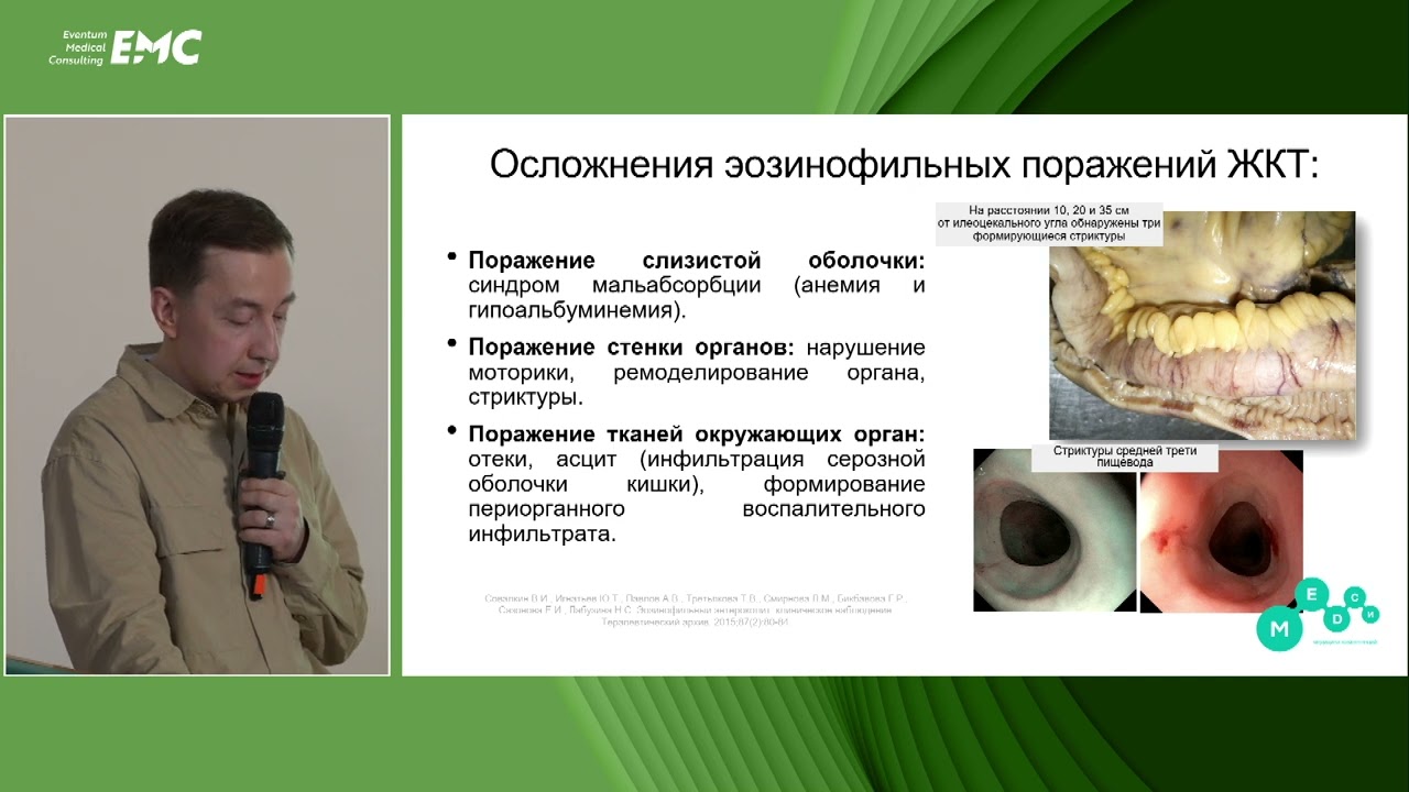 3. Эозинофильные поражения ЖКТ: что нового в этом мире? Валиулин И.Р, Агейкина Н.В, Старченков Д.Д.