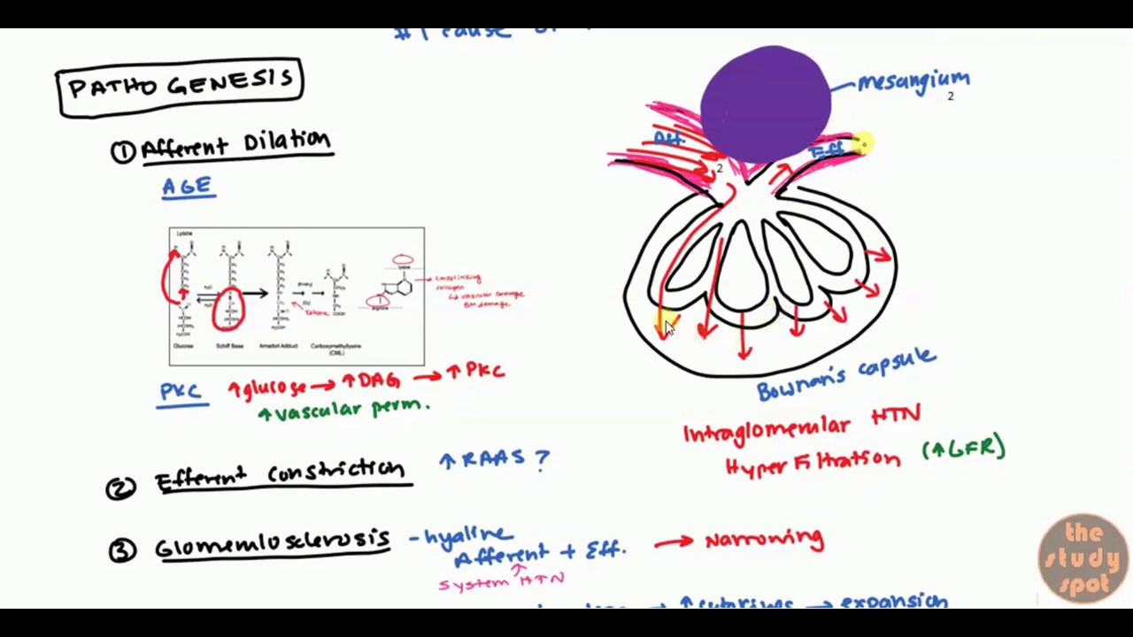 Диабетическая нефропатия для USMLE Step 1 и USMLE Step 2