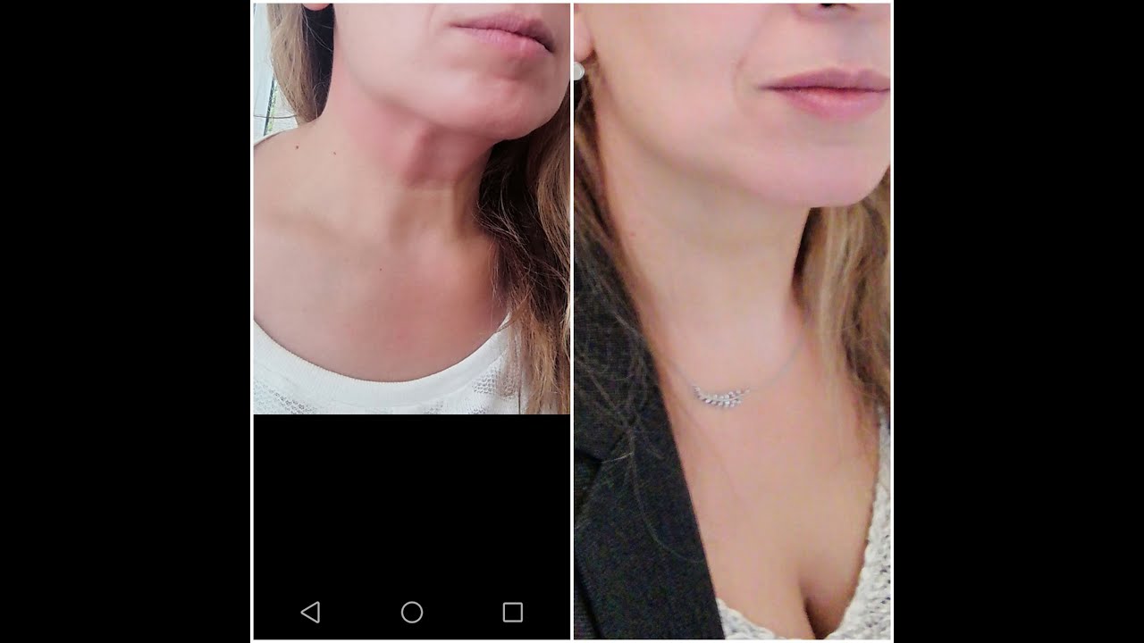 Comment enlever les rides, les tiges du cou et éviter le relâchement cutané