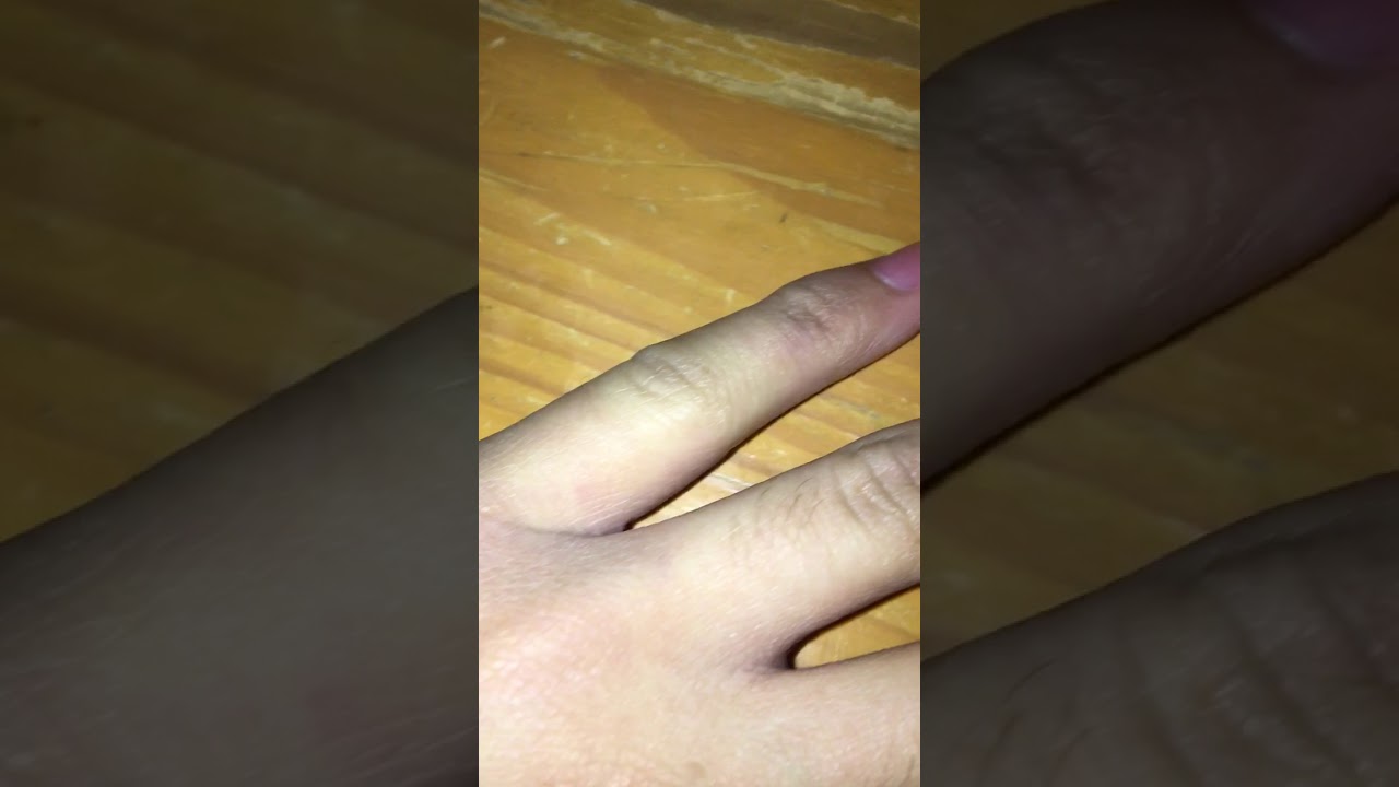 The update video of my broken finger