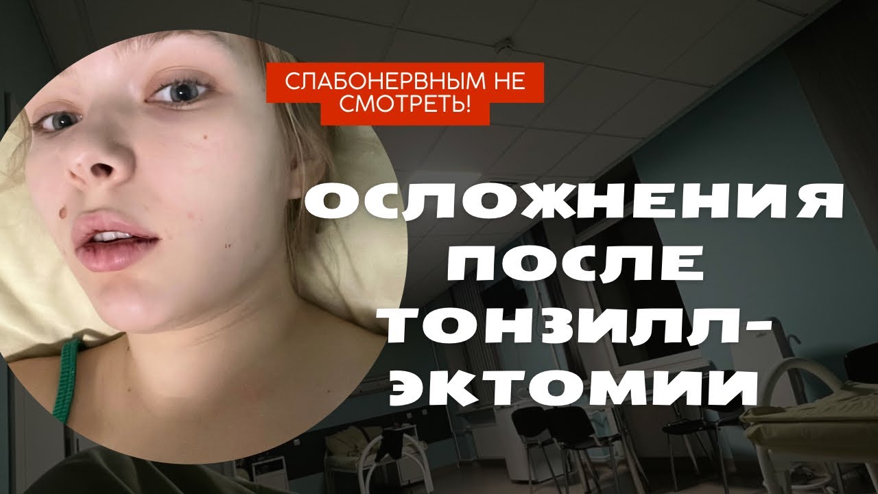 ОСЛОЖНЕНИЯ после тонзиллэктомии (операция по удалению миндалин) | ОТКРОВЕННЫЙ РАССКАЗ С ФОТО