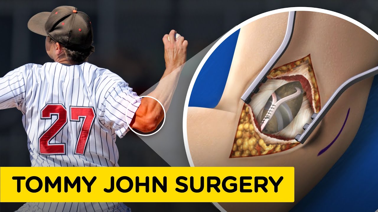 UCL Reconstruction Surgery (Tommy John Surgery) Medical Animation