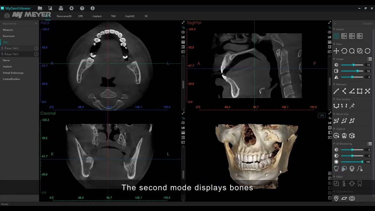 Meyer 3D Pro Mydent Viewer© yazılımı MPR çoklu planlı yeniden formatlama