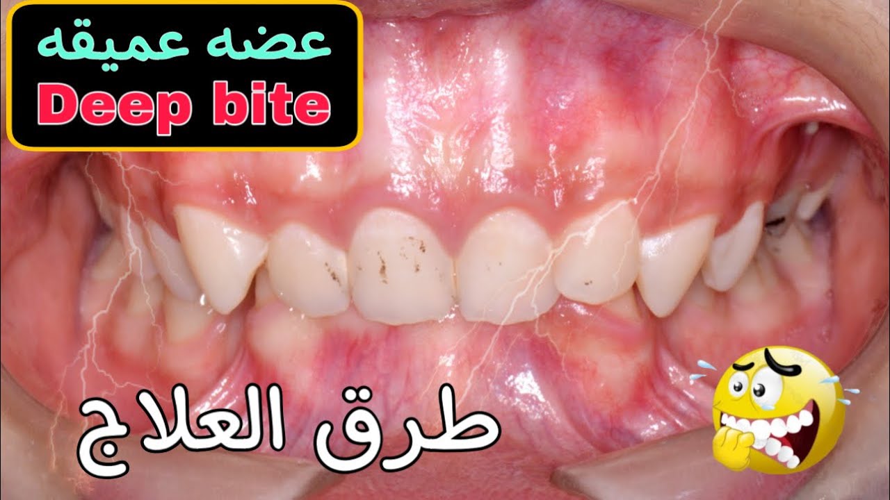 علاج العضه العميقة | Deep bite #yearofyou #dr_eslam_nabil #teeth #dentist #braces #comedy #تقويم