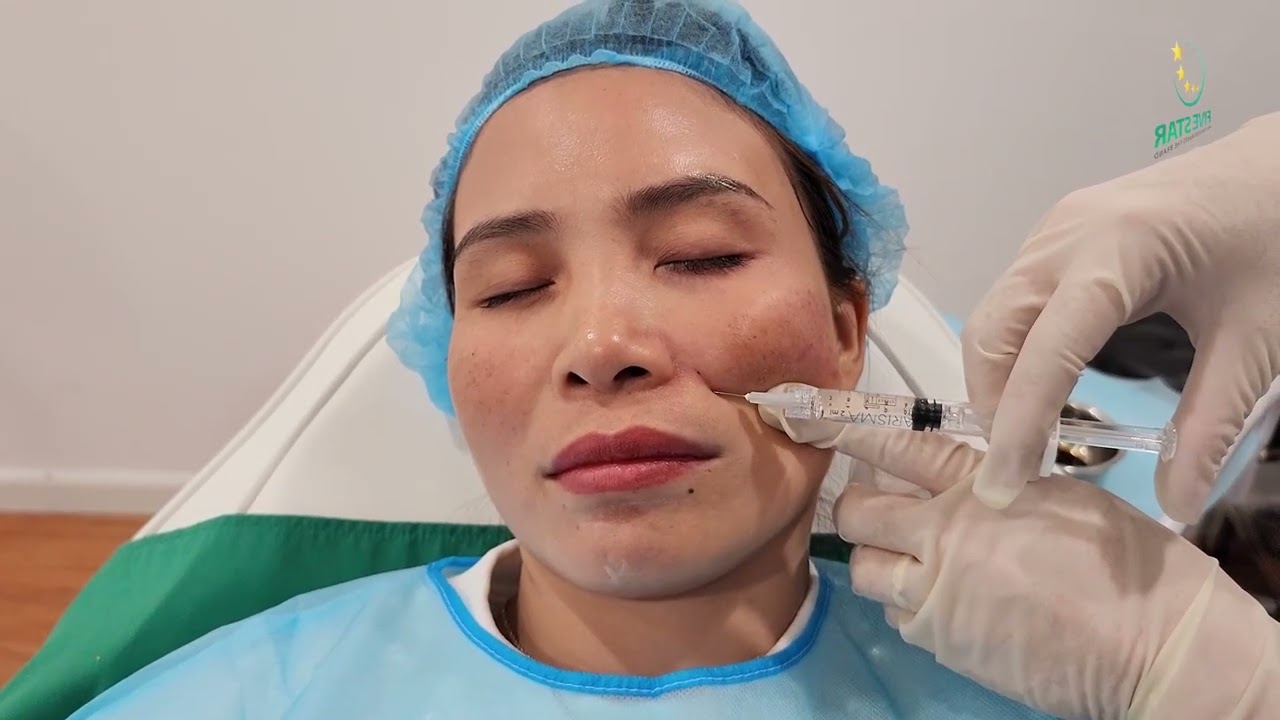 Karisma RH collagen: Kỹ thuật tiêm trẻ hóa da bằng cannula