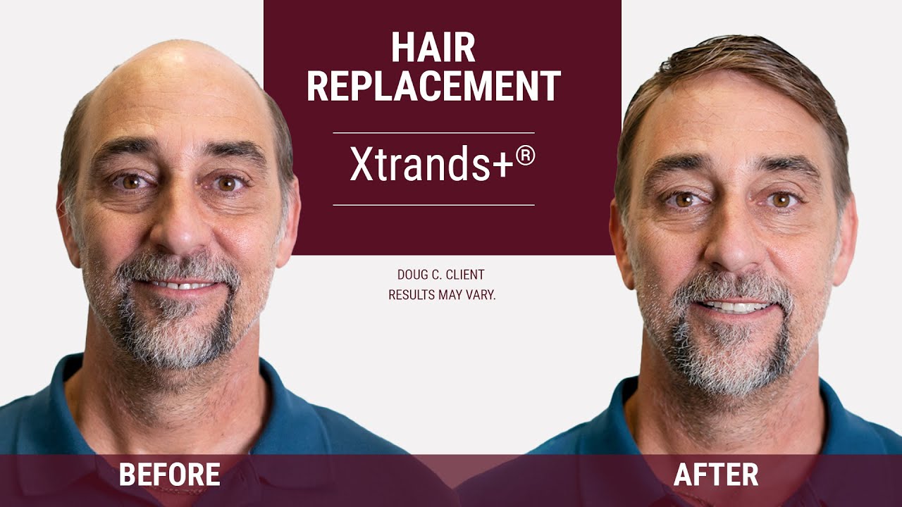 Get your hair back quickly 👨 | Hair Replacement Service