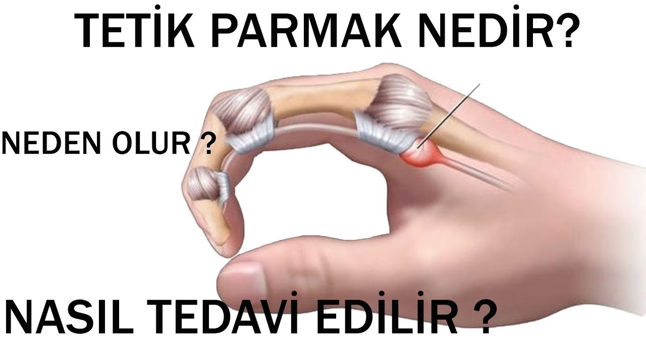 Tetik Parmak Hastalığı ?