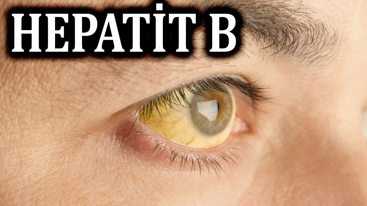 Hepatit B tam müalicə olunurmu? - DİQQƏT!