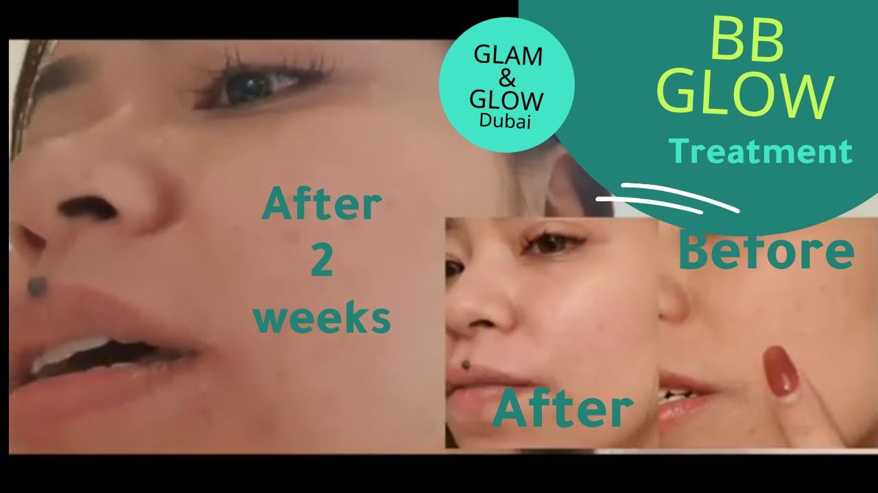 BB GLOW TREATMENT | 2 WEEKS after effect review | Glam and Glow-Dubai