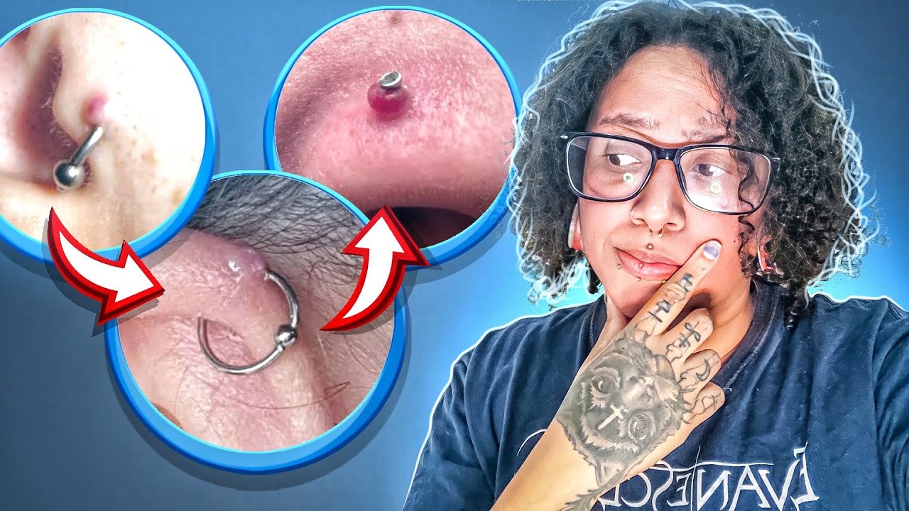 PRESCISA TIRAR O PIERCING PARA TRATAR O GRANULOMA ?