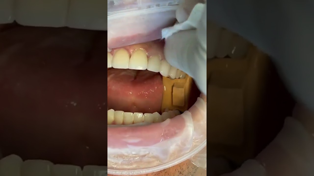 Natural-looking Full Veneers for a Confident Smile in Turkey  