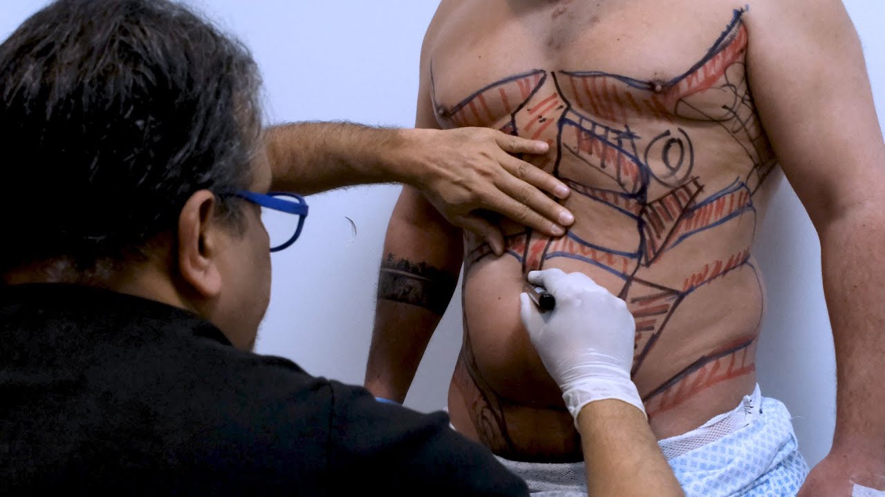 High-Definition Liposuction Marking Techniques with Dr. Sanjay Parashar and Dr. Matt Stefanelli