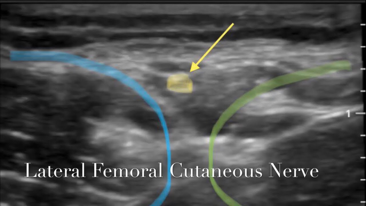 Ultrasonology of the Lateral Femoral Cutaneous Nerve