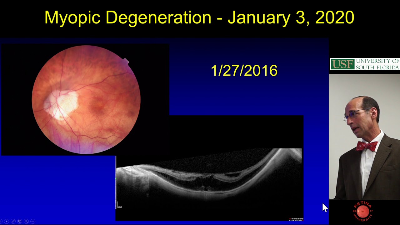 Myopic Degeneration - Ophthalmology Resident Lecture