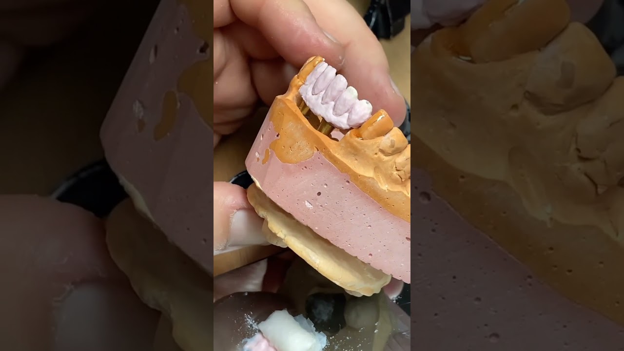 Build up implants of ceramic بناء  زرعات الاسنان