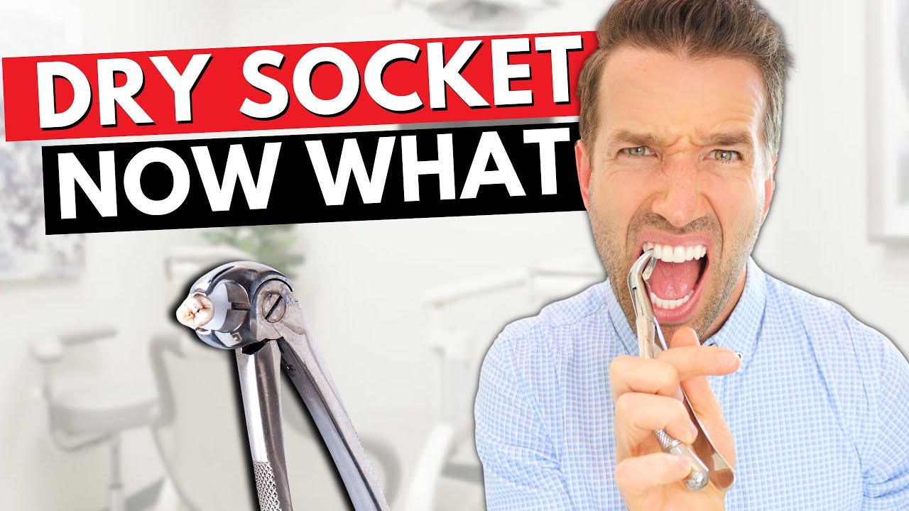 DRY SOCKET - Pain after tooth extraction : causes and cure