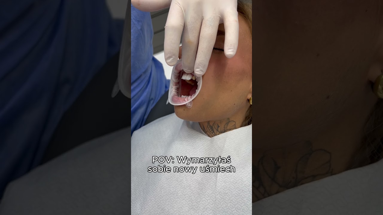 POV: Wymarzyłaś sobie nowy uśmiech #hollywoodsmile #zębywturcji #glowup #turcjazęby