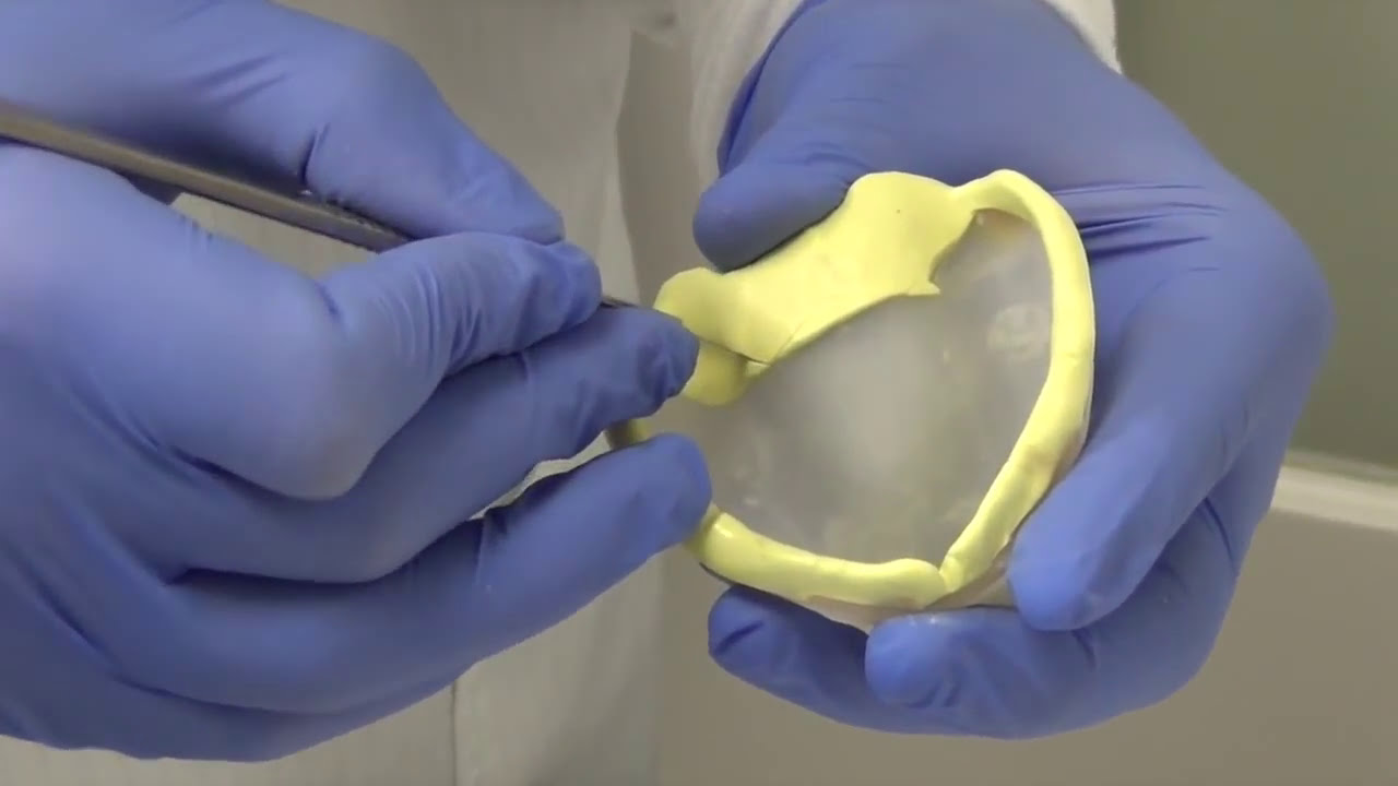 Custom Tray and PVS Edentulous Final Impression of the Maxilla