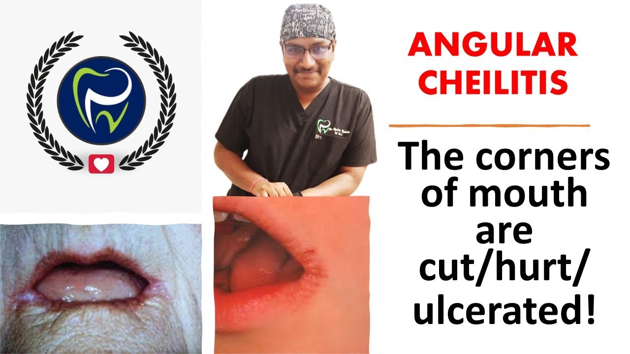 Dr Rudra Mohan | Angular Cheilitis | The corners of my mouth are cracked/ulcerated / hurt!!