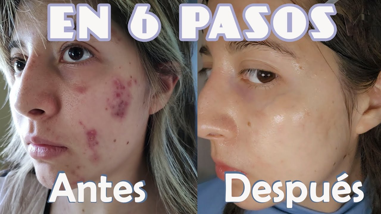 Como curé mi acné en 6 pasos: Recomendaciones de dermatólogos, productos, alimentación y más 