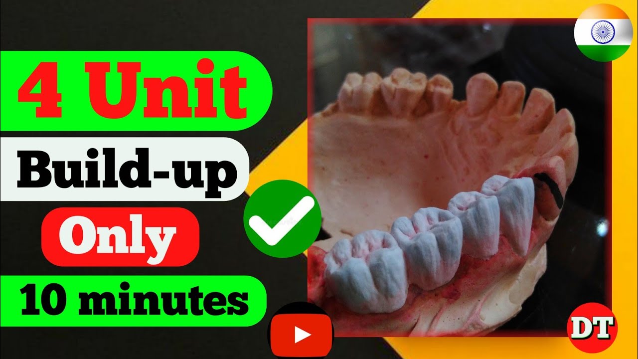 Layering| Upper 4 unit build up| Metal Ceramic| Ceramics| posterior Build up| Dental technician| Lab