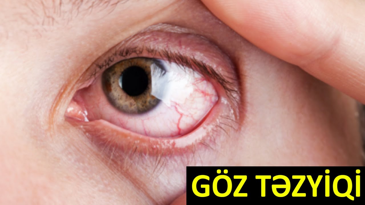 Gözündə təzyiq olanlar - İZLƏYİN