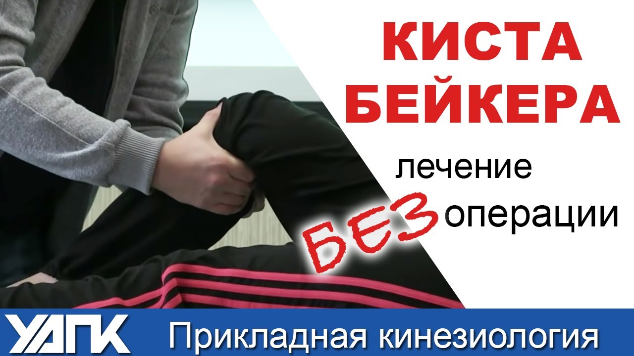 КАК лечить кисту Бейкера БЕЗ операции? Прикладная кинезиология.