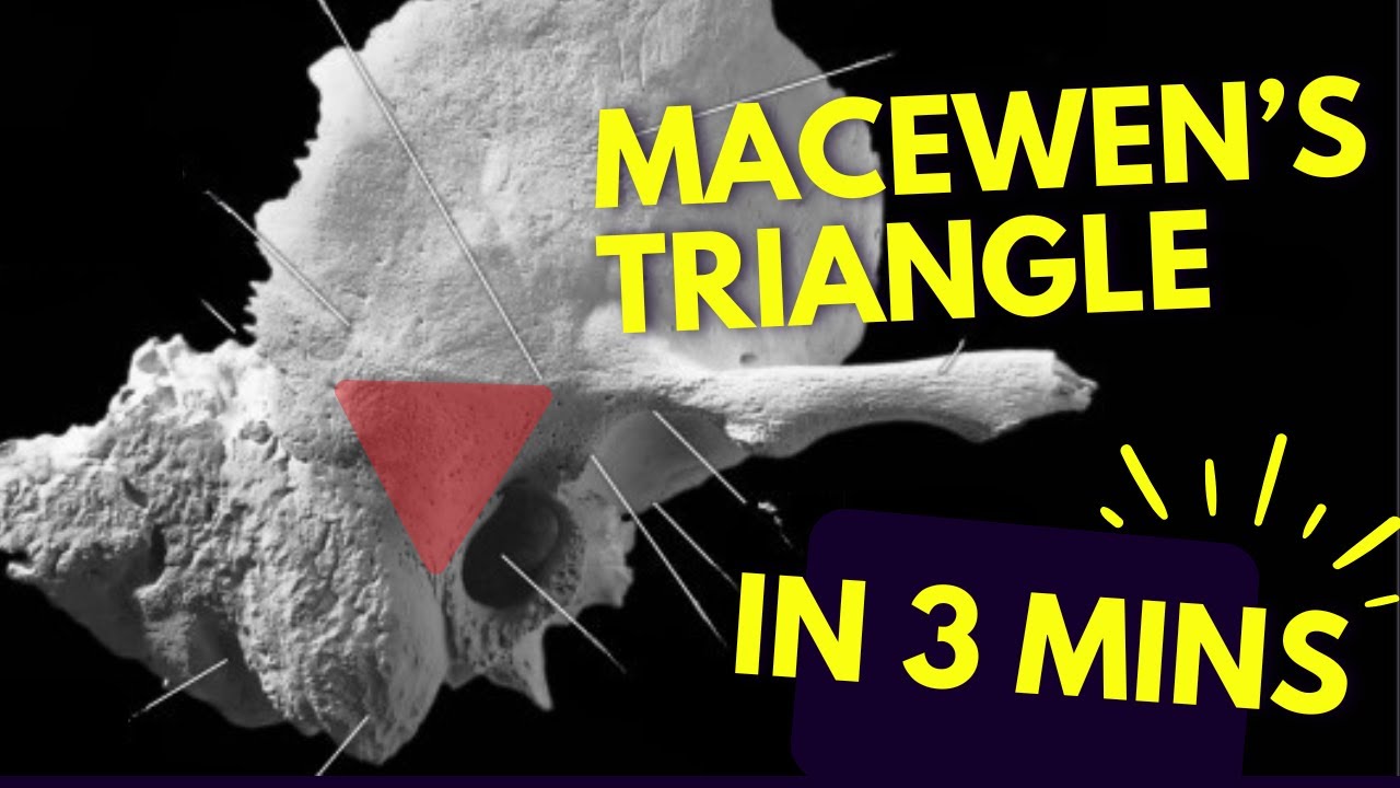 Macewen's Triangle 📐 in just THREE minutes! ⏱️