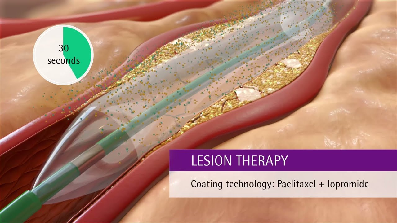 SeQuent&reg; Please NEO: The implant-free alternative for treating coronary artery disease