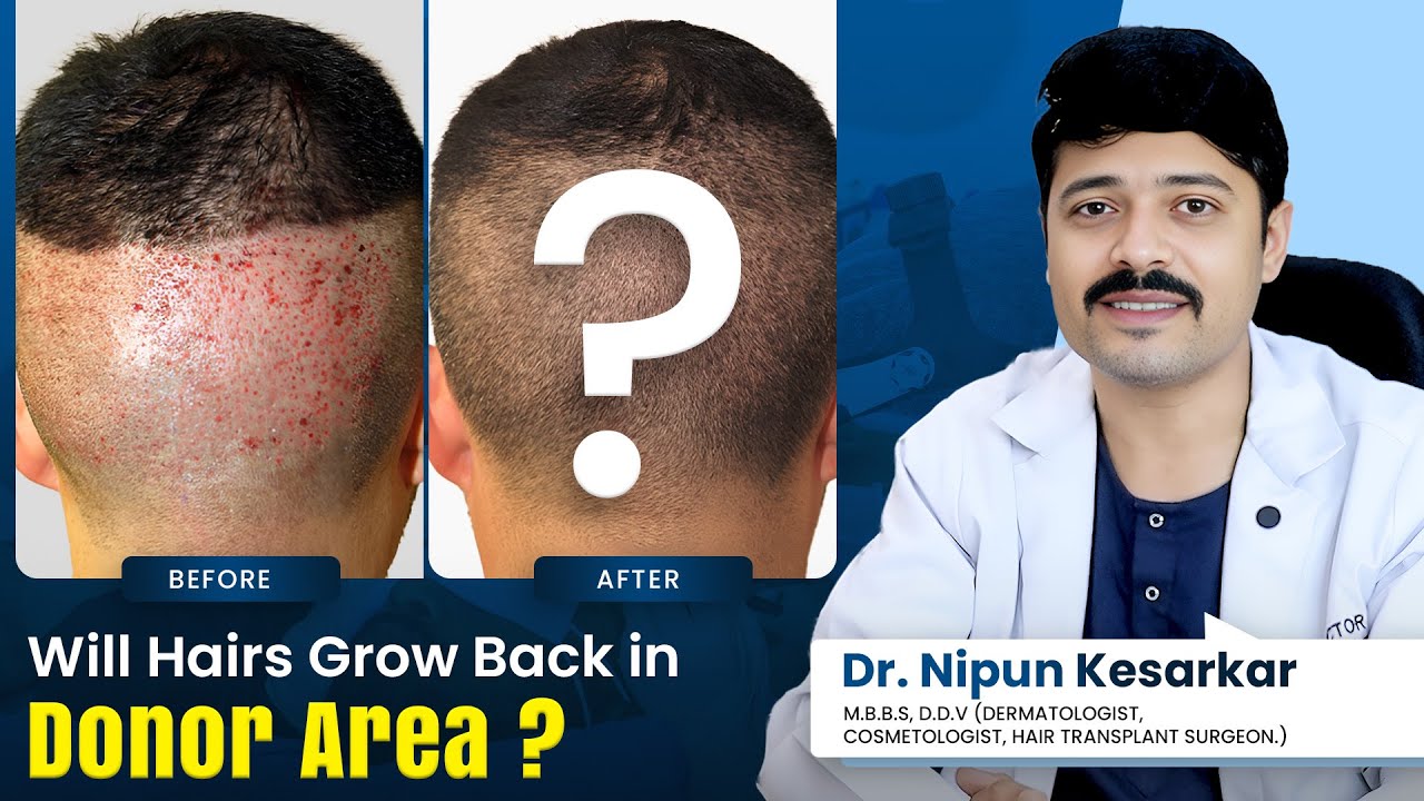 Donor Area Recovery: Will Hair Regrow After My Hair Transplant? Dr. Nipun Answers #hairtransplant