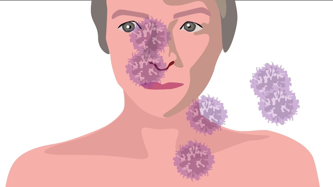 What is follicular lymphoma?